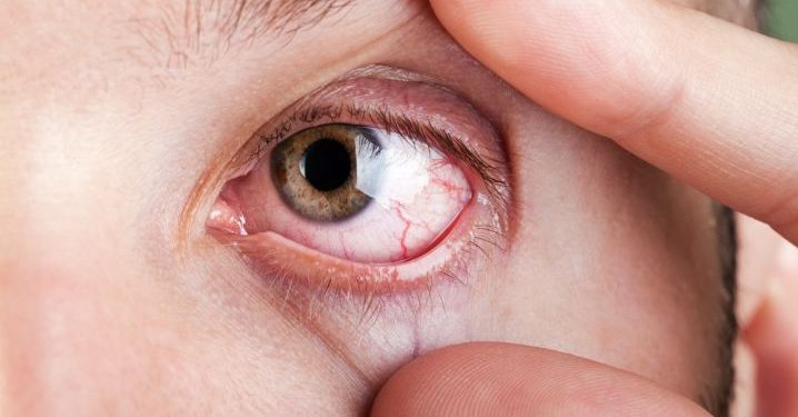 Recognizing Retinal Tear Symptoms