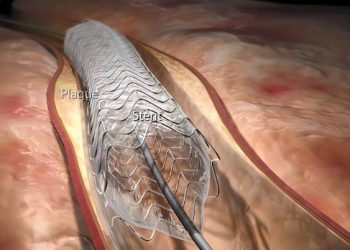 Catheter Ablation Symptoms