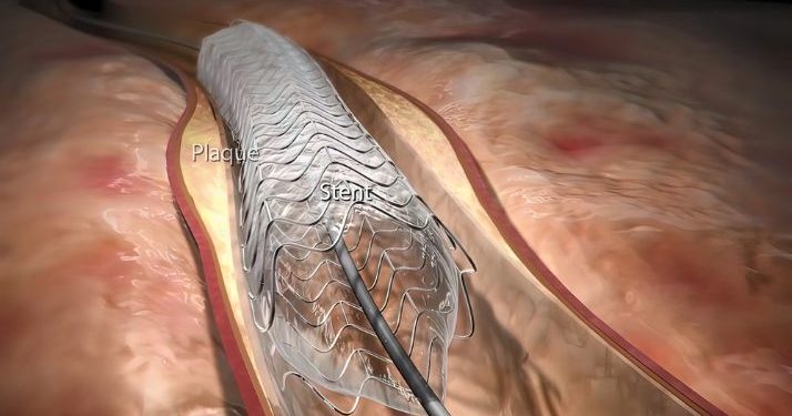Catheter Ablation Symptoms