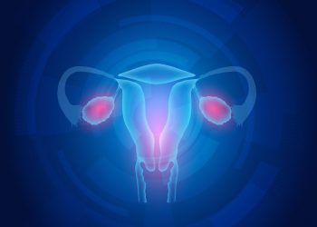 Ovarian Cancer Symptoms