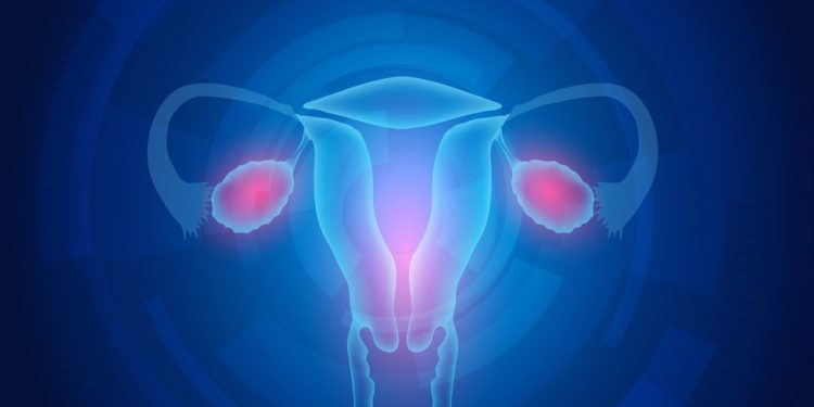 Ovarian Cancer Symptoms