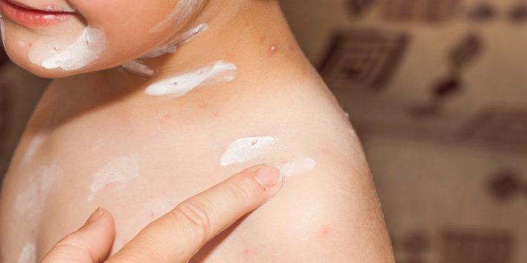 Chickenpox Symptoms and How They Affect the Body