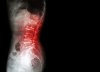 Osteopenia Treatments