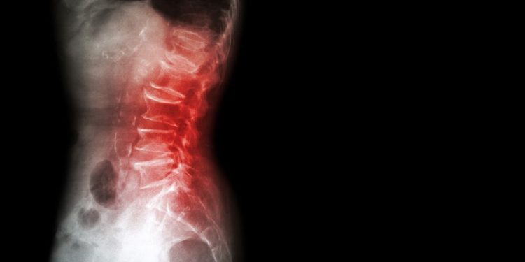 Osteopenia Treatments