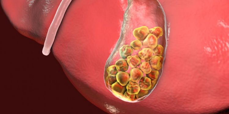 Biliary Atresia in Infants