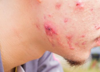 Food Allergy Symptoms