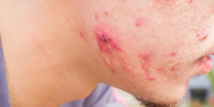 Food Allergy Symptoms