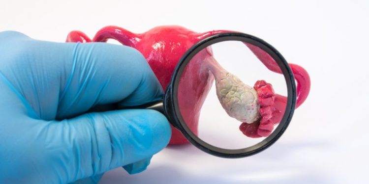 Anovulation Symptoms and Causes