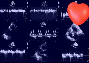 Mitral Regurgitation Symptoms and Treatment
