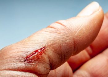 Sepsis Symptoms and Treatment