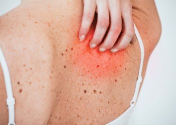 All About Allergy Symptoms