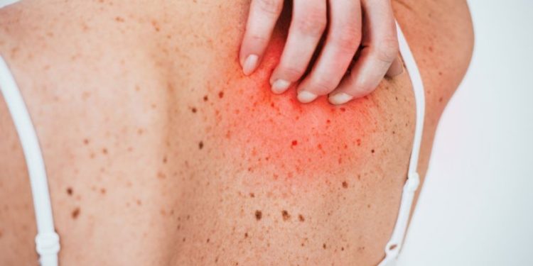 All About Allergy Symptoms