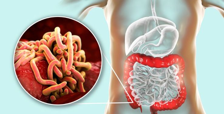 What Are Enterobius Vermicularis Symptoms?