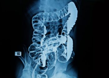 Mesenteric Insufficiency Symptoms and Treatment