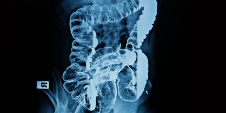 Mesenteric Insufficiency Symptoms and Treatment