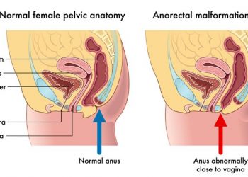 Anorectal Incontinence Symptoms and Treatments