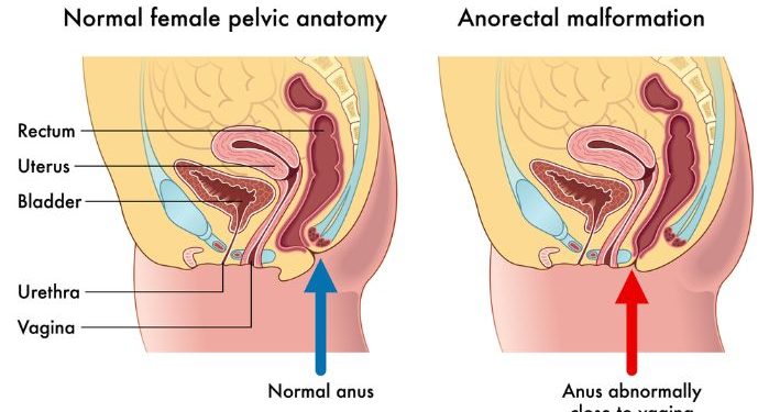 Anorectal Incontinence Symptoms and Treatments