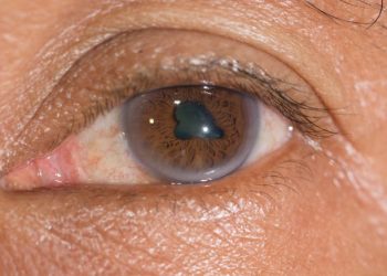 Endophthalmitis Symptoms and Causes