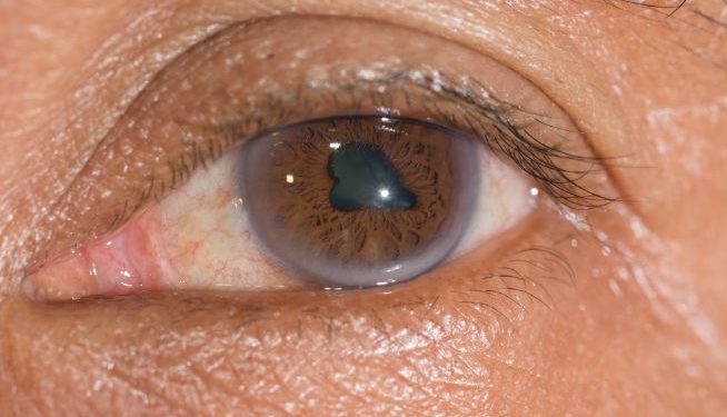 Endophthalmitis Symptoms and Causes