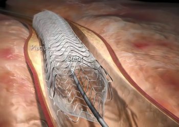Aortic Regurgitation Symptoms