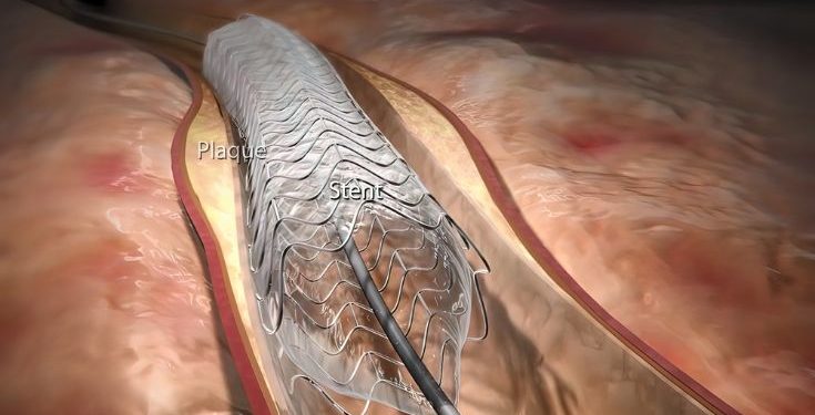 Aortic Regurgitation Symptoms