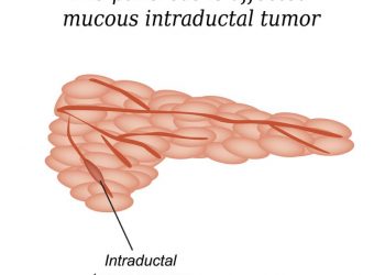 Exocrine Pancreatic Insufficiency