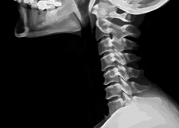 Head and Neck Primary Tumors Symptoms and Treatment