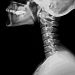 Head and Neck Primary Tumors Symptoms and Treatment