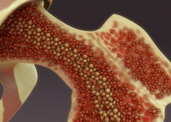 Bone Marrow Depression