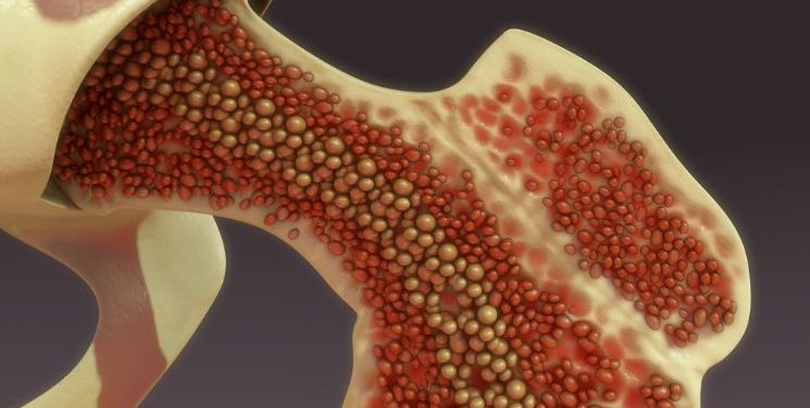 Bone Marrow Depression