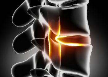 What Are Bulging Disc Symptoms?