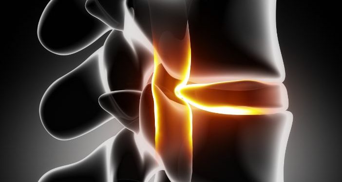 What Are Bulging Disc Symptoms?