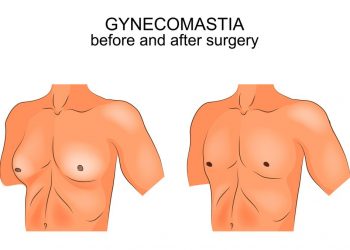 Gynecomastia Treatments