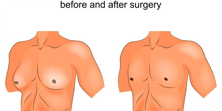 Gynecomastia Treatments