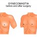 Gynecomastia Treatments
