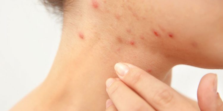 Acne Symptoms