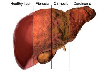 Blastocystis Hominis