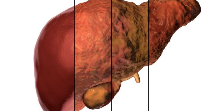 Blastocystis Hominis