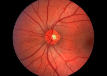 Aortic Dissection and Other Blood Vessel Symptoms in Children