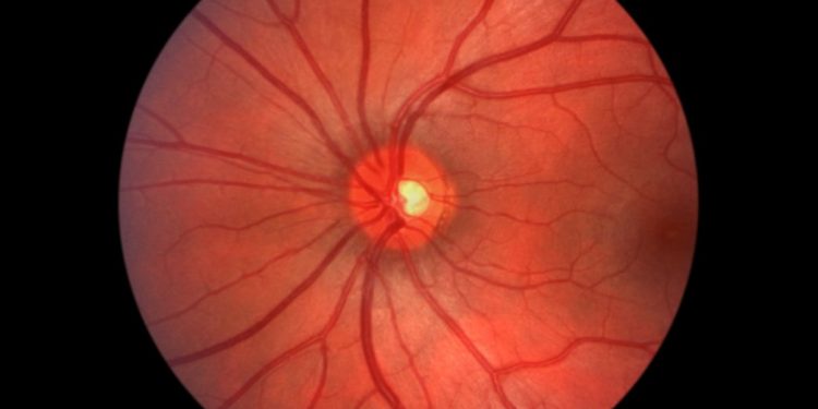 Aortic Dissection and Other Blood Vessel Symptoms in Children