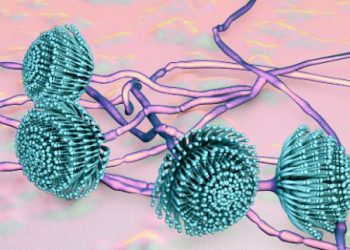 Aspergillosis Symptoms