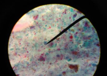 Giardia Lamblia Symptoms