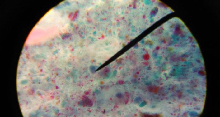 Giardia Lamblia Symptoms