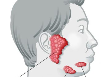 Symptoms of Salivary Glands Tumors