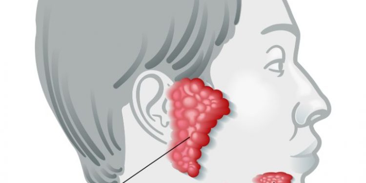 Symptoms of Salivary Glands Tumors