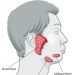 Symptoms of Salivary Glands Tumors