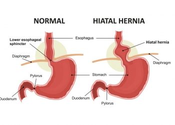 Hiatal Hernia Symptoms