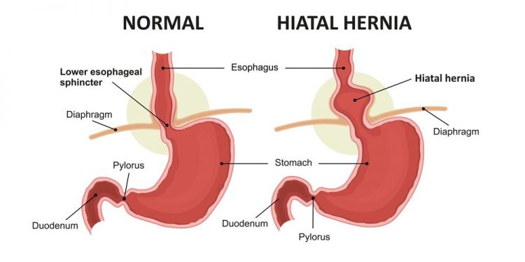 Hiatal Hernia Symptoms