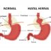Hiatal Hernia Symptoms