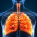 Lung Hernia Symptoms